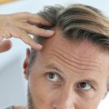 Hair loss